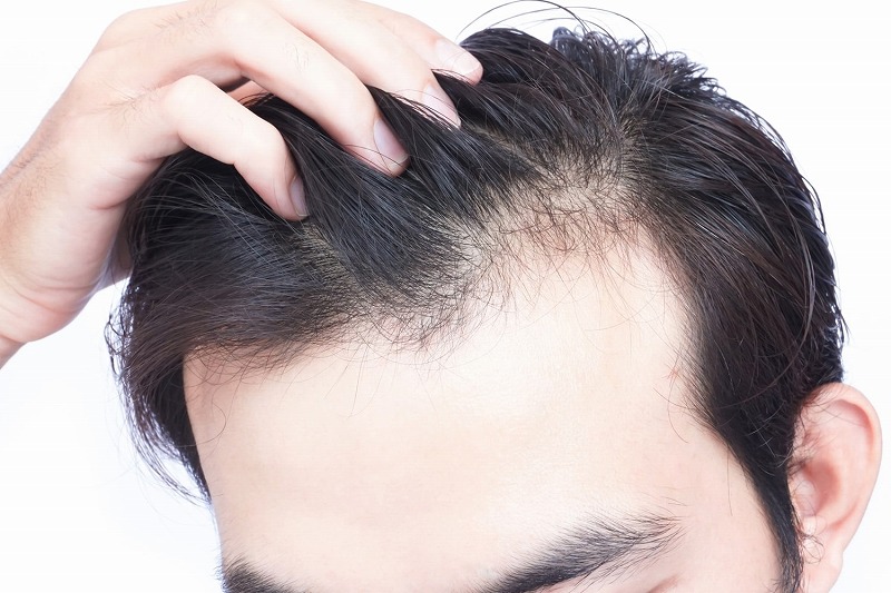 男性の禿（薄毛）の原因と対策